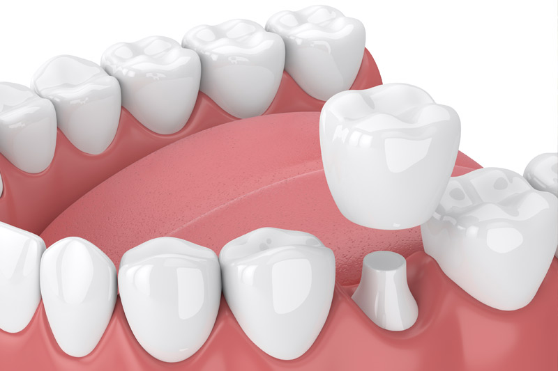 Dental Crowns in La Grange